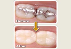 تجاری سازی نانو کامپوزیت های دندانی در کشور