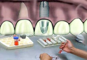نانوکامپوزیت دندانپزشکی با خواص بهینه در کشور ساخته شد