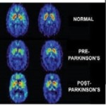 نانوزیست حسگری برای شناسایی زودهنگام پارکینسون