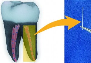 بهبود موادپرکننده دندانپزشکی با نانوذرات الماس و آنتیبیوتیک